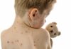 Beyond His Birthmark: A Boy Refuses to Hide Child with red spots on back holding a teddy bear