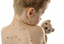 Beyond His Birthmark: A Boy Refuses to Hide Child with red spots on back holding a teddy bear